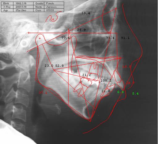 矯正診断・分析：セファロメトリックス（セファロ分析） | 大松矯正